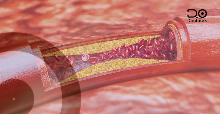 أمراض-الأوعية-الدموية