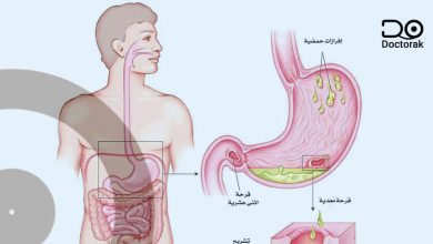 القرحة الهضمية