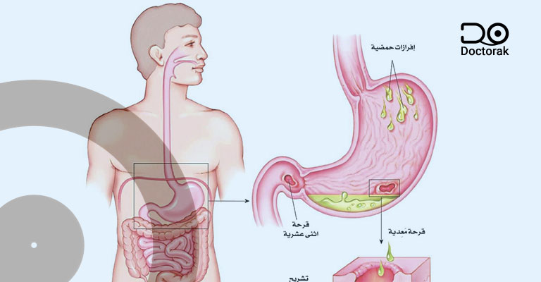 القرحة الهضمية