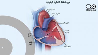 عيب الحاجز البطيني