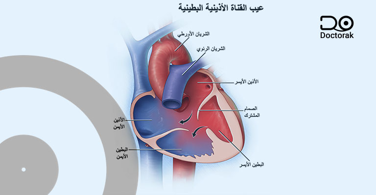 عيب الحاجز البطيني