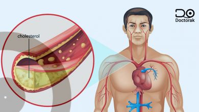 اعراض ارتفاع الكوليسترول