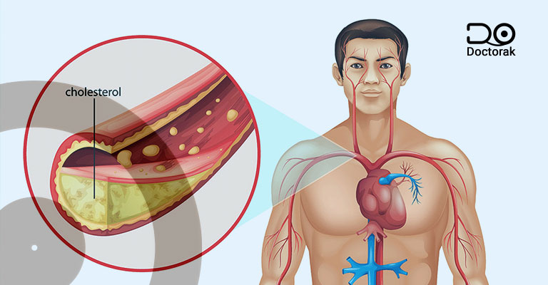 اعراض ارتفاع الكوليسترول